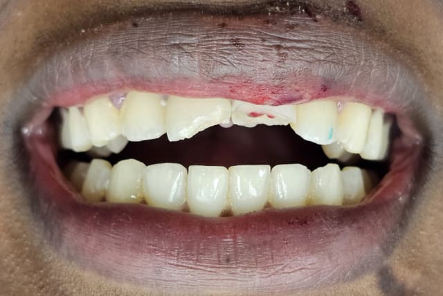 dental abscess treatment manchester